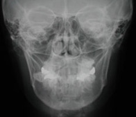 正貌頭部X線規格写真