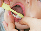 5.下顎左側　乳歯の奥歯の外側の面