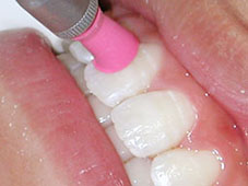 歯の表面に付着している汚れやヤニ（くすみ）を取り除く