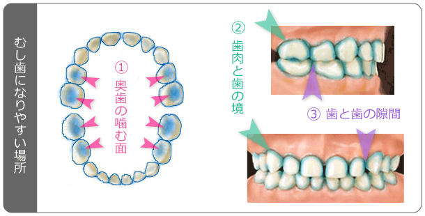 奥歯の噛む面、歯肉と歯の境、歯と歯の隙間はむし歯になりやすい場所